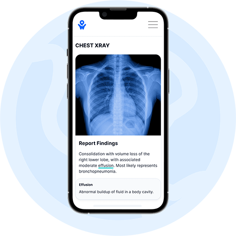 PocketHealth's Report Reader highlighted on a phone