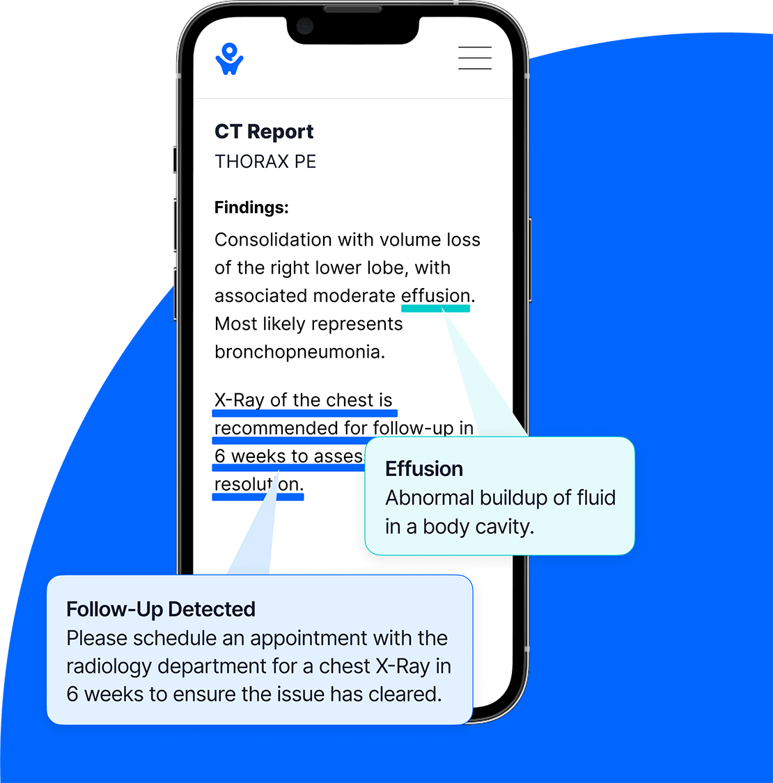 CT report on a mobile phone screen with pop-ups displaying the words Effusion and Follow-Up Detected within the PocketHealth platform.