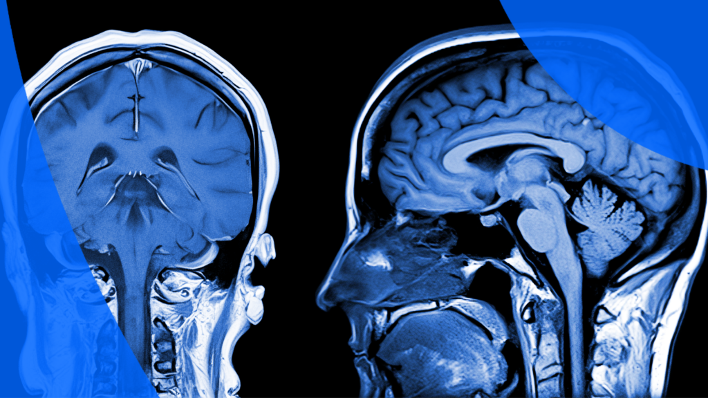How to Read MRI Results: Interpreting Your Report &amp; Terminology