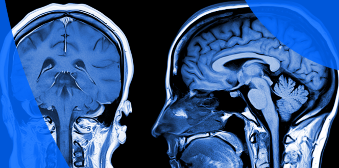 MRI of brain - coronal and lateral AP
