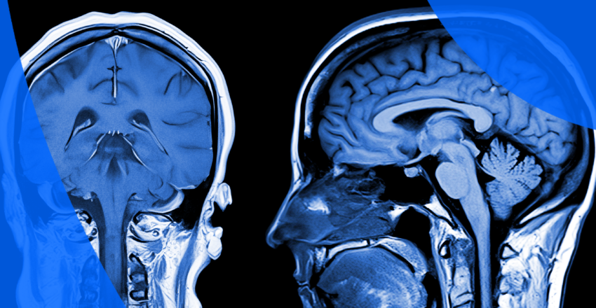MRI of brain - coronal and lateral AP