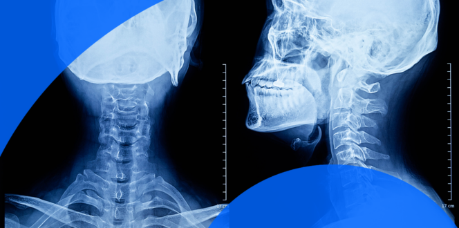 X-ray of skull AP and lateral view