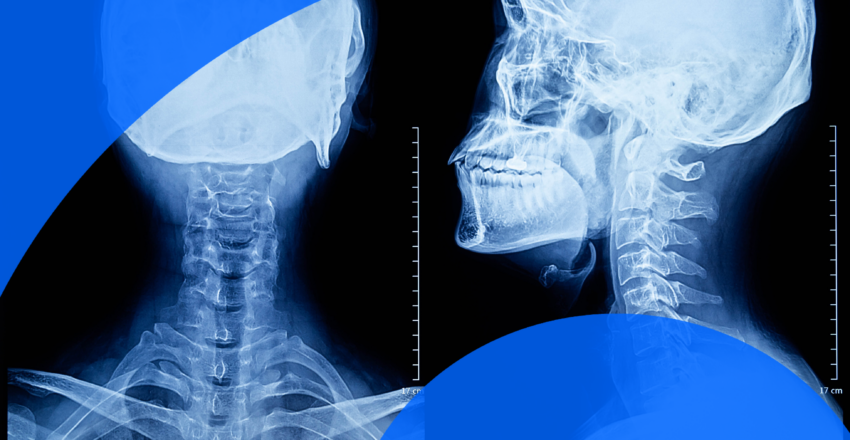 X-ray of skull AP and lateral view