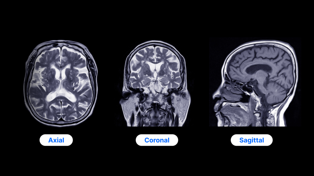 MRI with axial, coronal and sagittal views