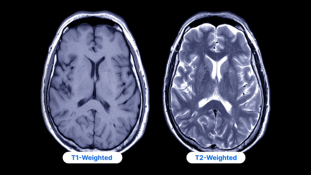 MRIs showing the difference between T1 and T2 weighted scans