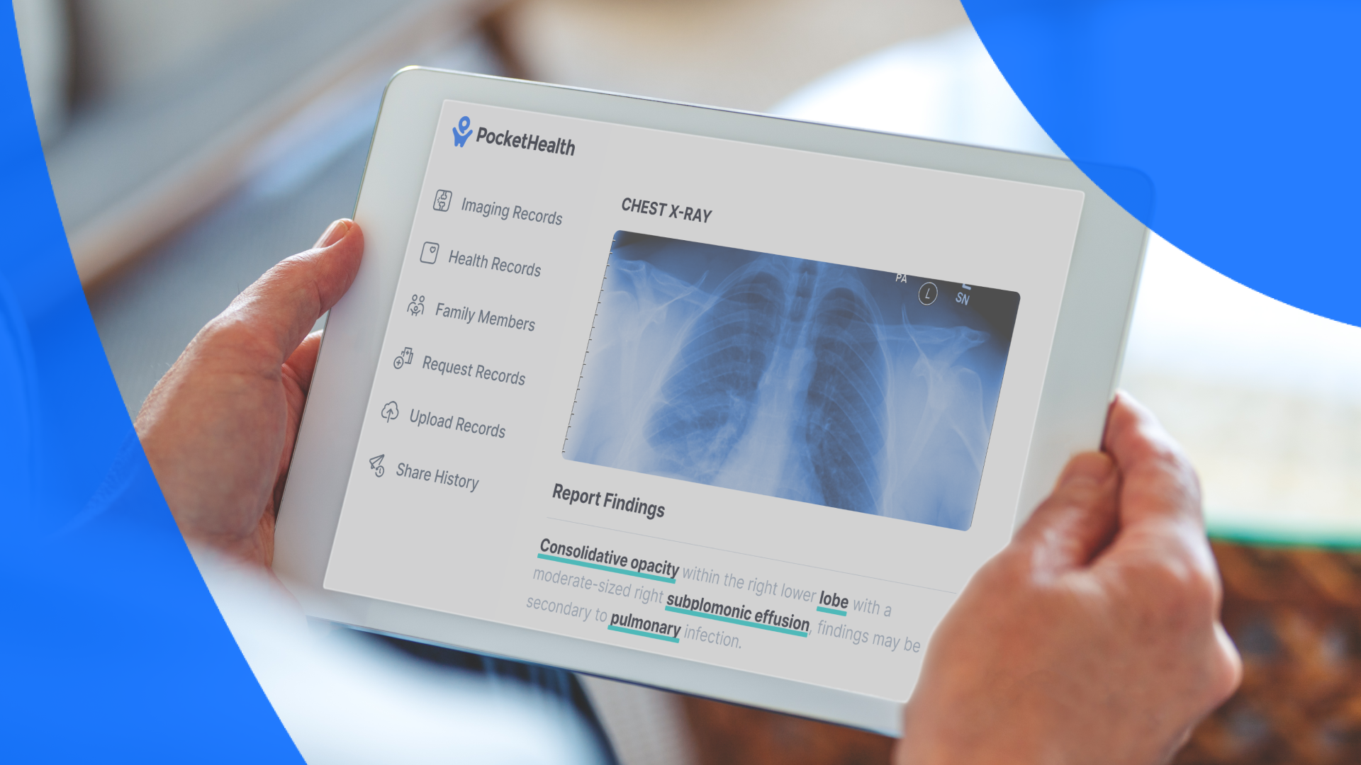How to Read an XRay Report Lucency, Acute Abnormality & More