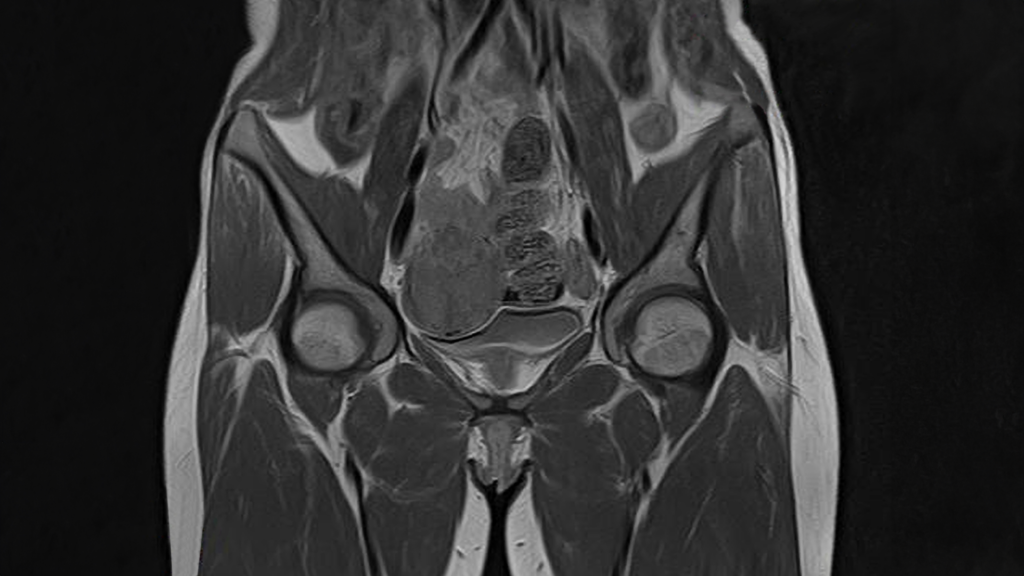 Uterine MRI with contrast
