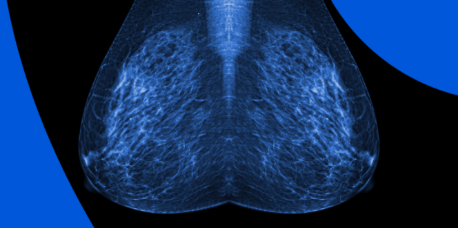 Mammogram original