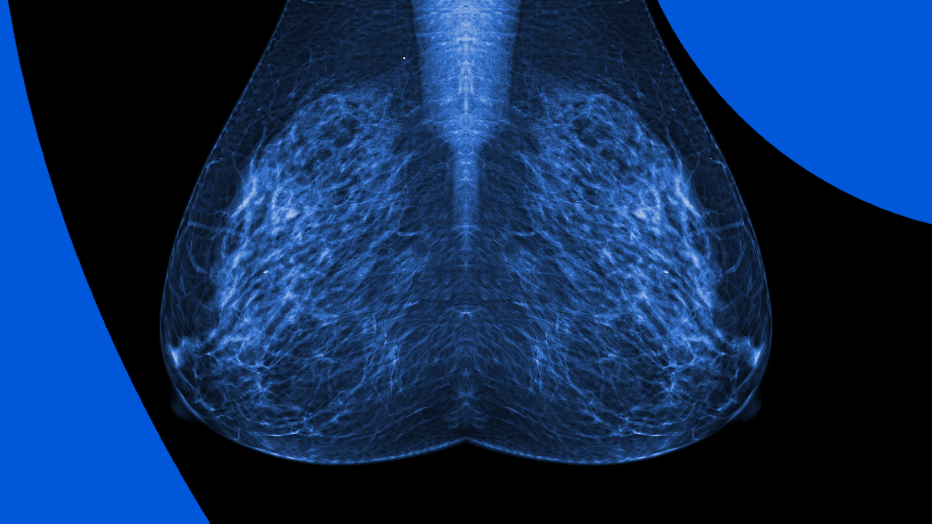 Mammograms, Breast Ultrasounds and MRI's: What's It All Mean?