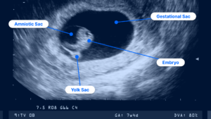 Labeled diagram of a pregnancy ultrasound image at 7 weeks