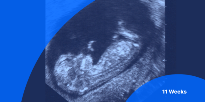 11 Weeks Pregnant Ultrasound Image of Fetus