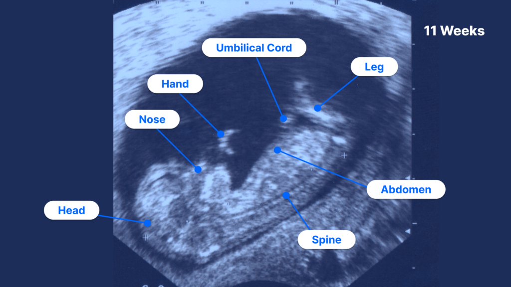 Human Fetus 11 Weeks