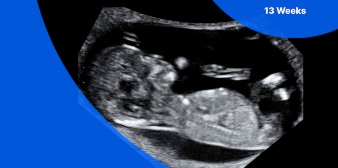 13 weeks pregnant ultrasound image of fetus