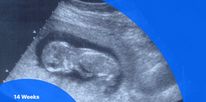 14 weeks pregnant ultrasound image of fetus