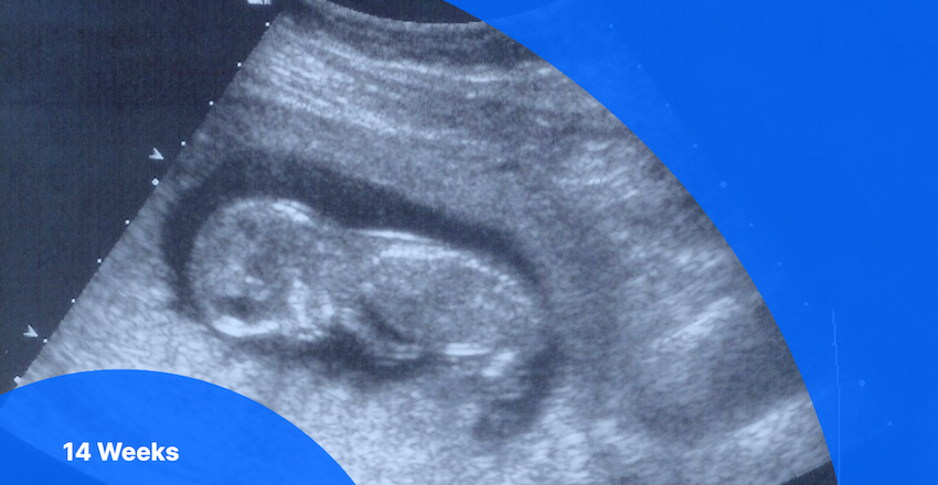 14 weeks pregnant ultrasound image of fetus