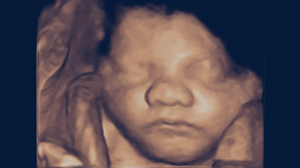Example of a 3D Toronto Ultrasound Image