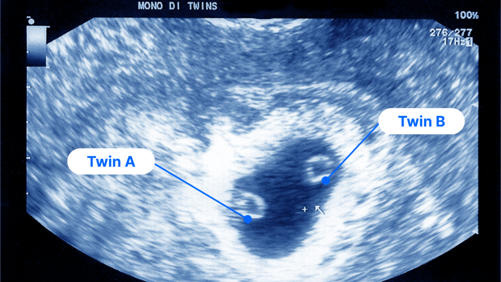Six week ultrasound of twin fetuses