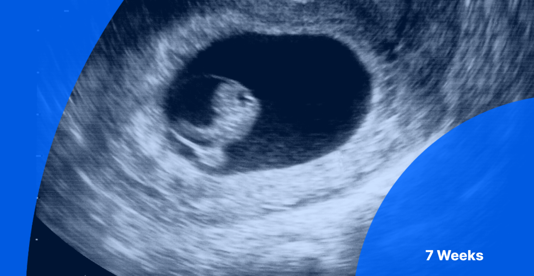 7 weeks pregnant ultrasound image of embryo