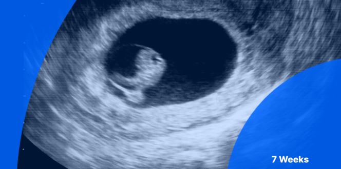 7 weeks pregnant ultrasound image of embryo