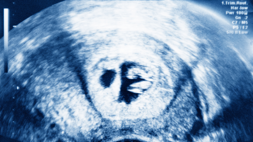 7 week ultrasound of twin fetuses