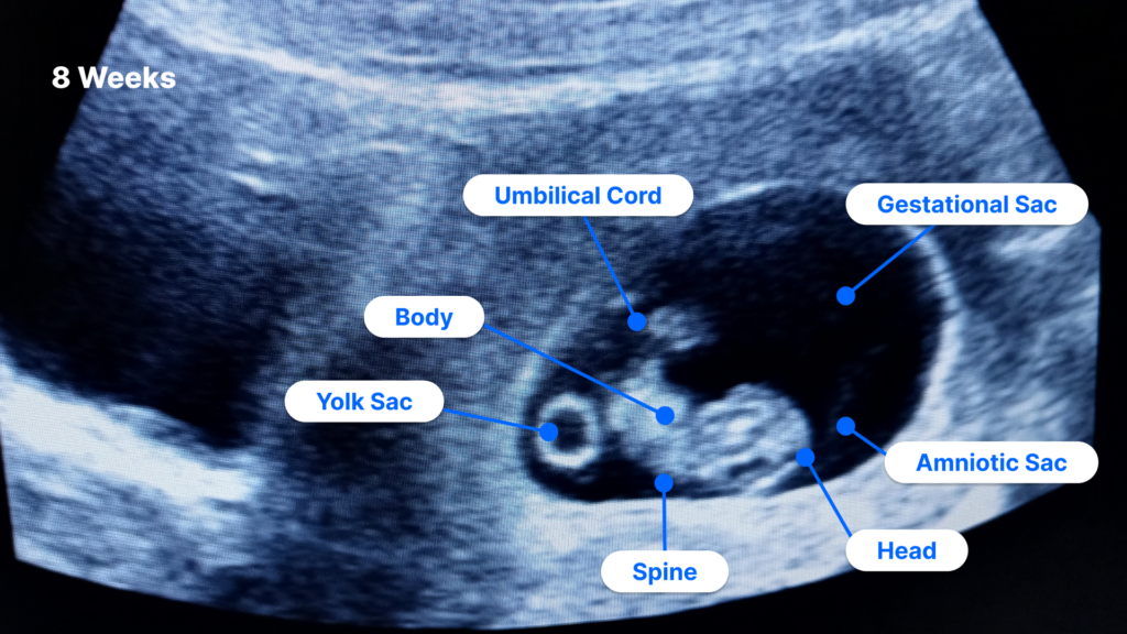 8 weeks pregnant ultrasound labeled diagram
