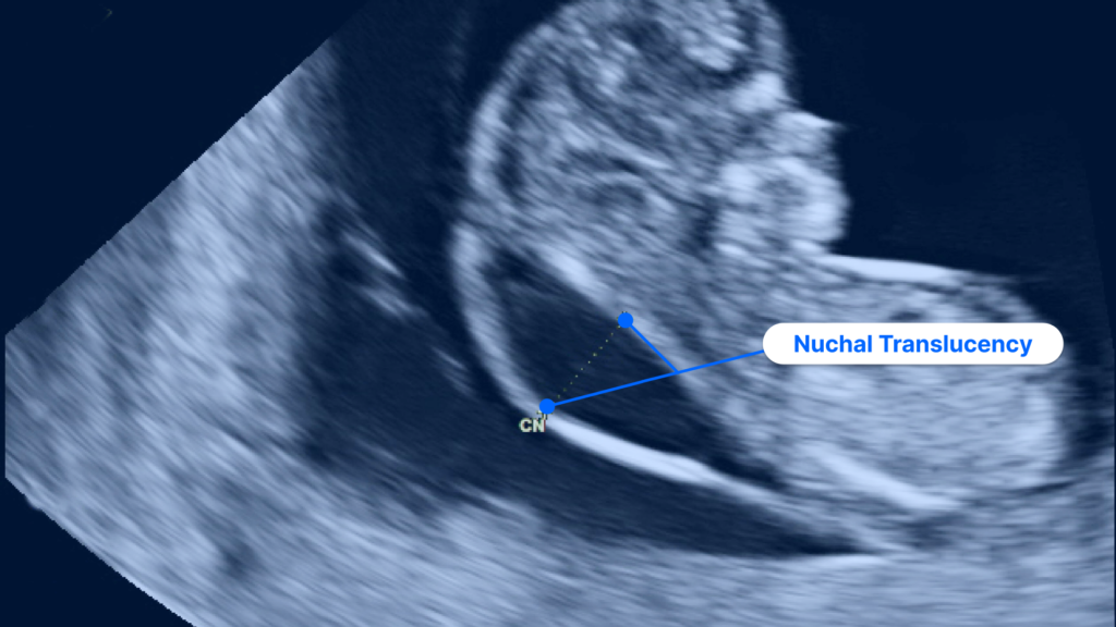 11 Weeks Pregnant Ultrasound Image Showing Nuchal Translucency Measurement