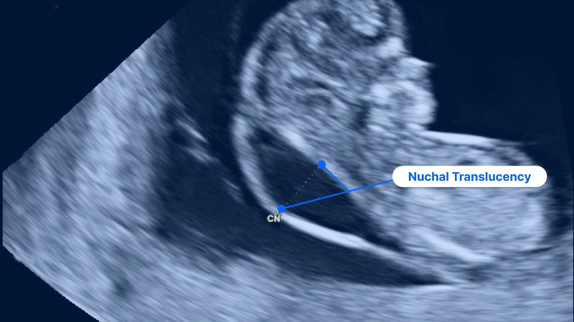 11 week ultrasound pictures fetus size what to expect
