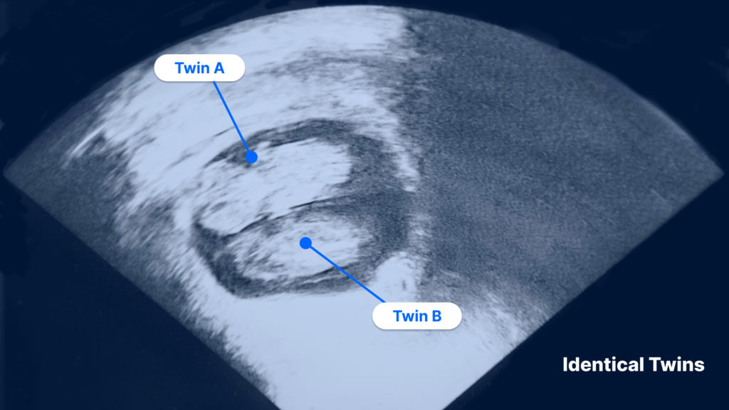 10 week ultrasound of identical twins