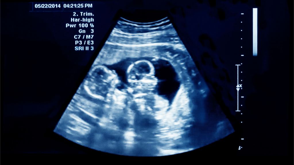 Twin pregnancy on an ultrasound