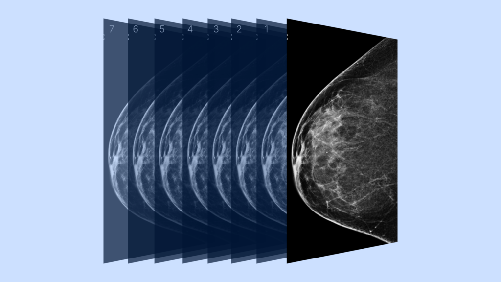 3D mammogram example showing multiple 2D image slices