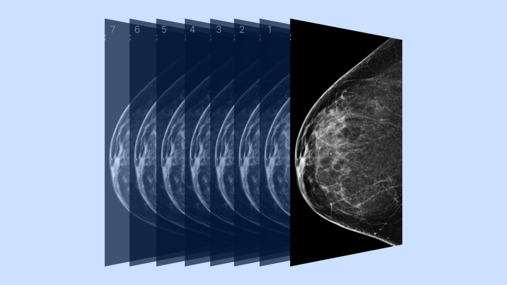 3D vs 2D mammography for detecting cancer in dense breasts