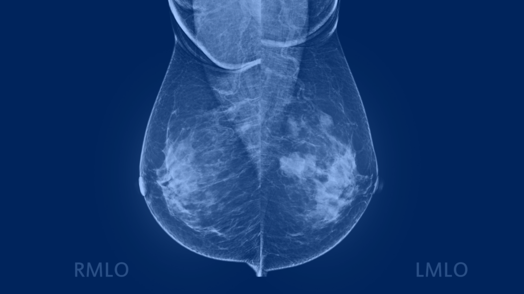 Labeled diagnostic mammogram showing BI-RADS 4 malignant tumor