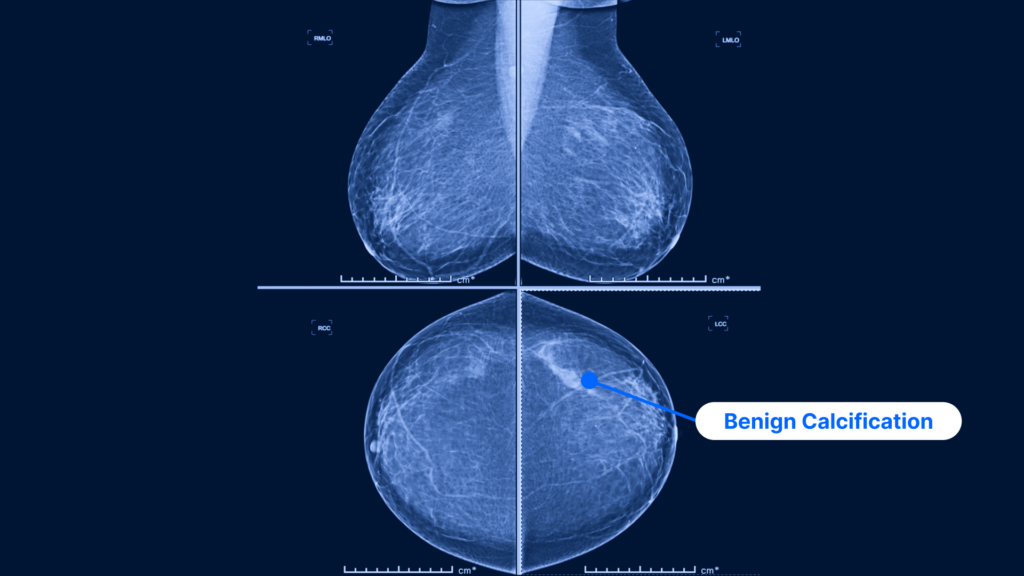 Mammogram screening showing BI-RADS 2 benign calcification