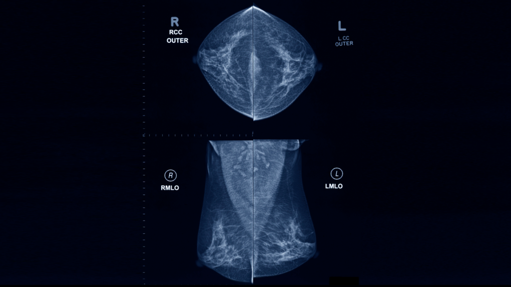 A 2d mammogram
