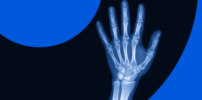 Can I See My X-Rays Online? x-ray image of a hand
