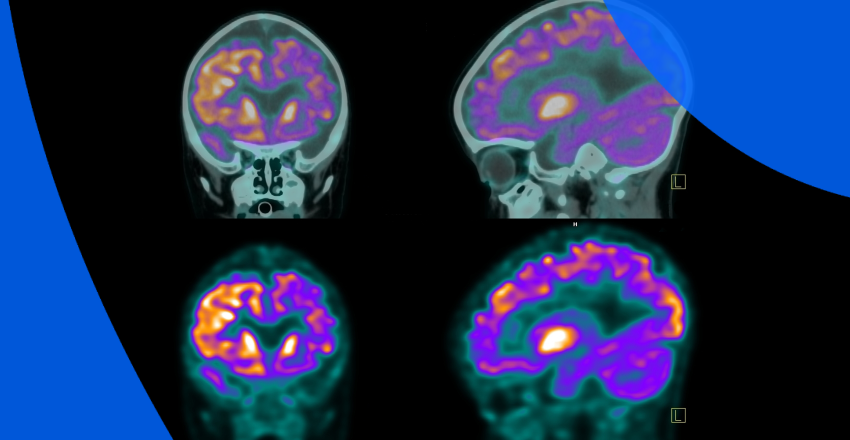 How to Read a PET Scan Report