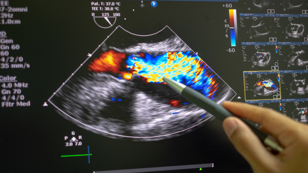A Doppler echocardiogram