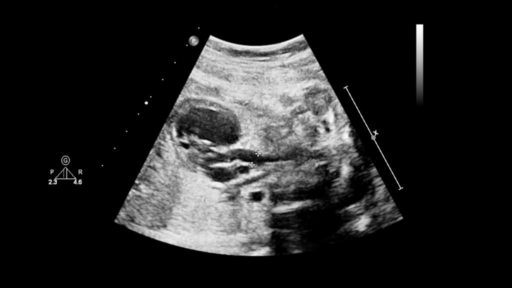 Fetal echocardiogram