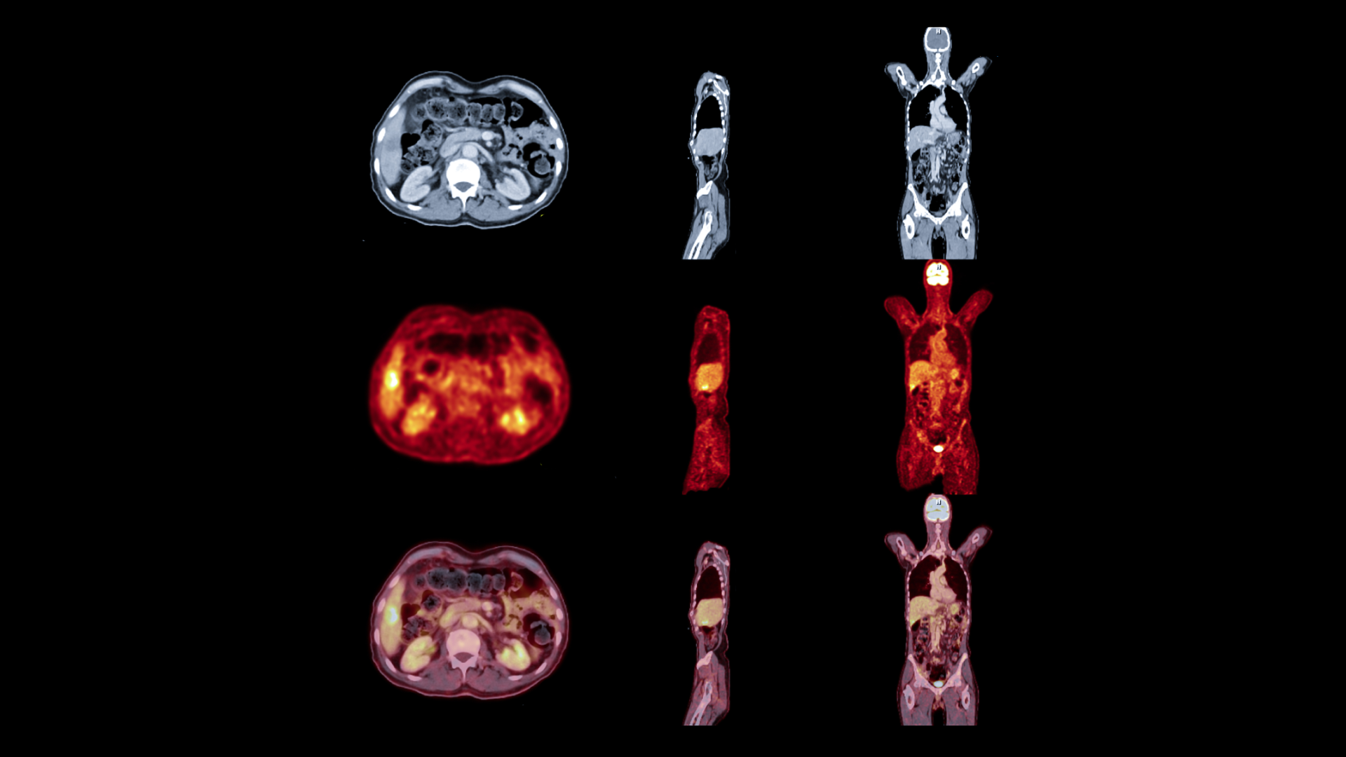How to Read PET Scan Results: FDG Uptake, SUV and More