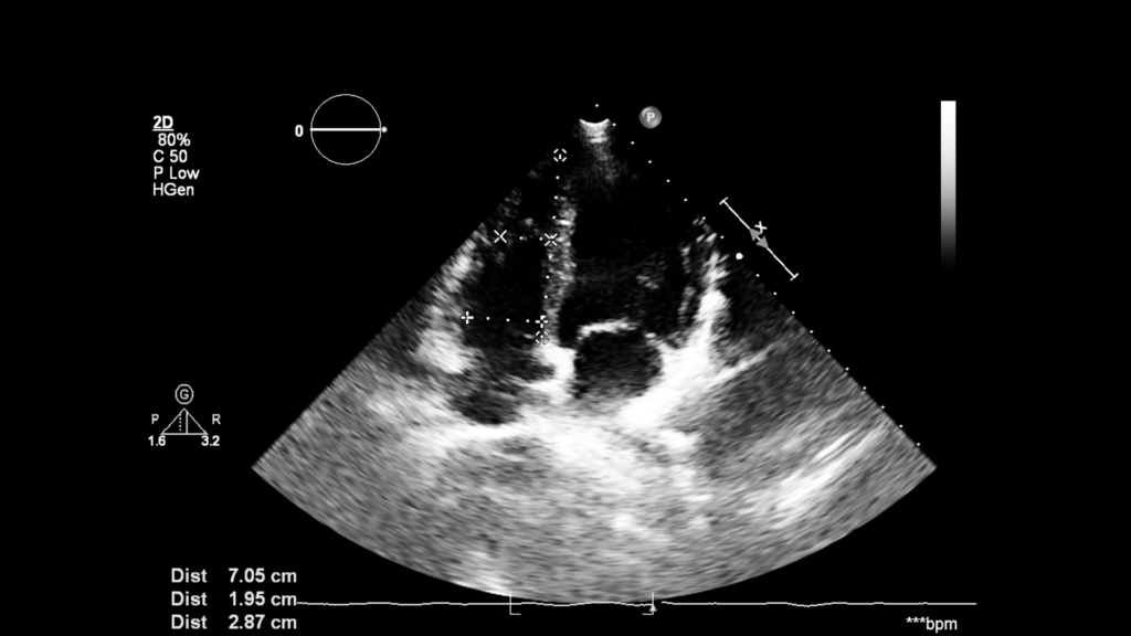 A transesophageal heart ultrasound 