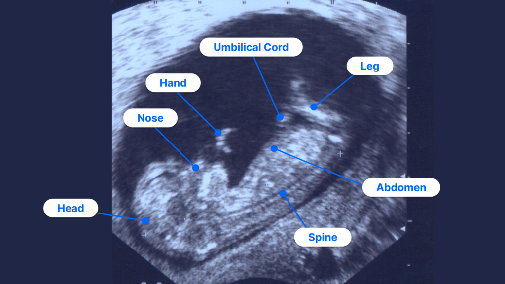 How to read an ultrasound picture of an 11 week fetus