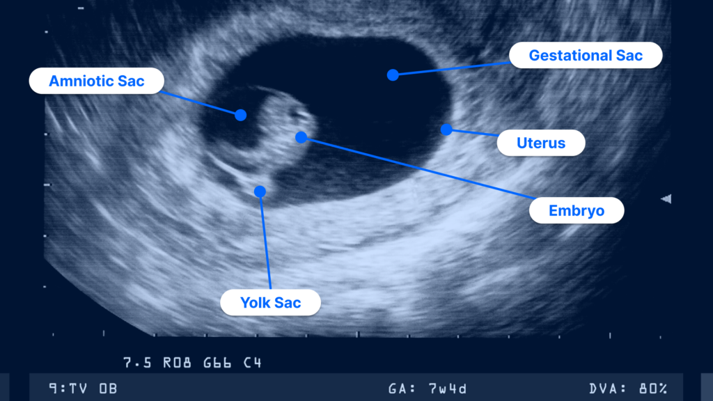 How to read an ultrasound picture of a 7 week embryo