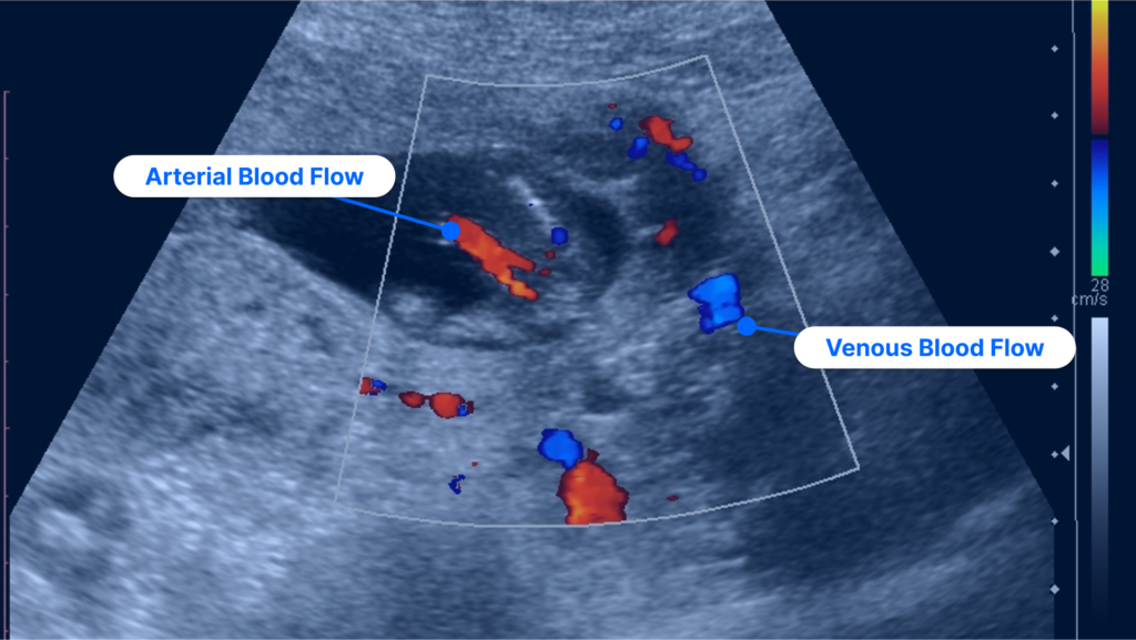 How to read an ultrasound picture of a doppler ultrasound showing arterial vs venous blood flow
