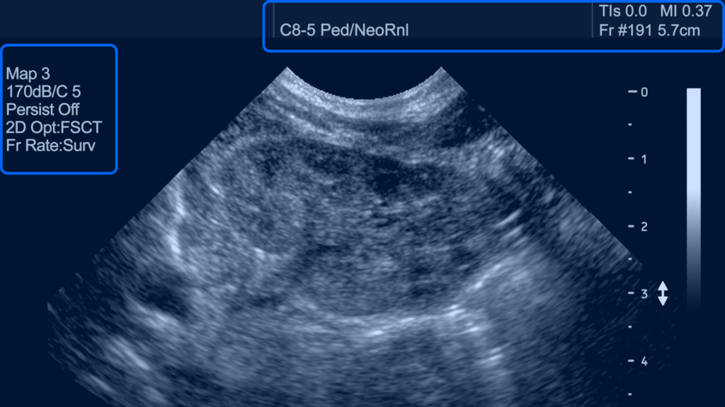 How to read an ultrasound picture of a newborn kidney