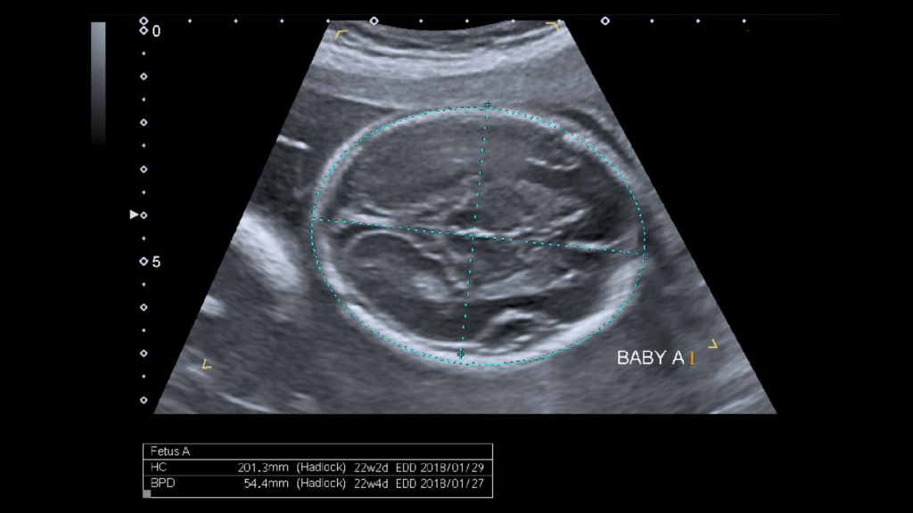 Ultrasound showing BPD and HC