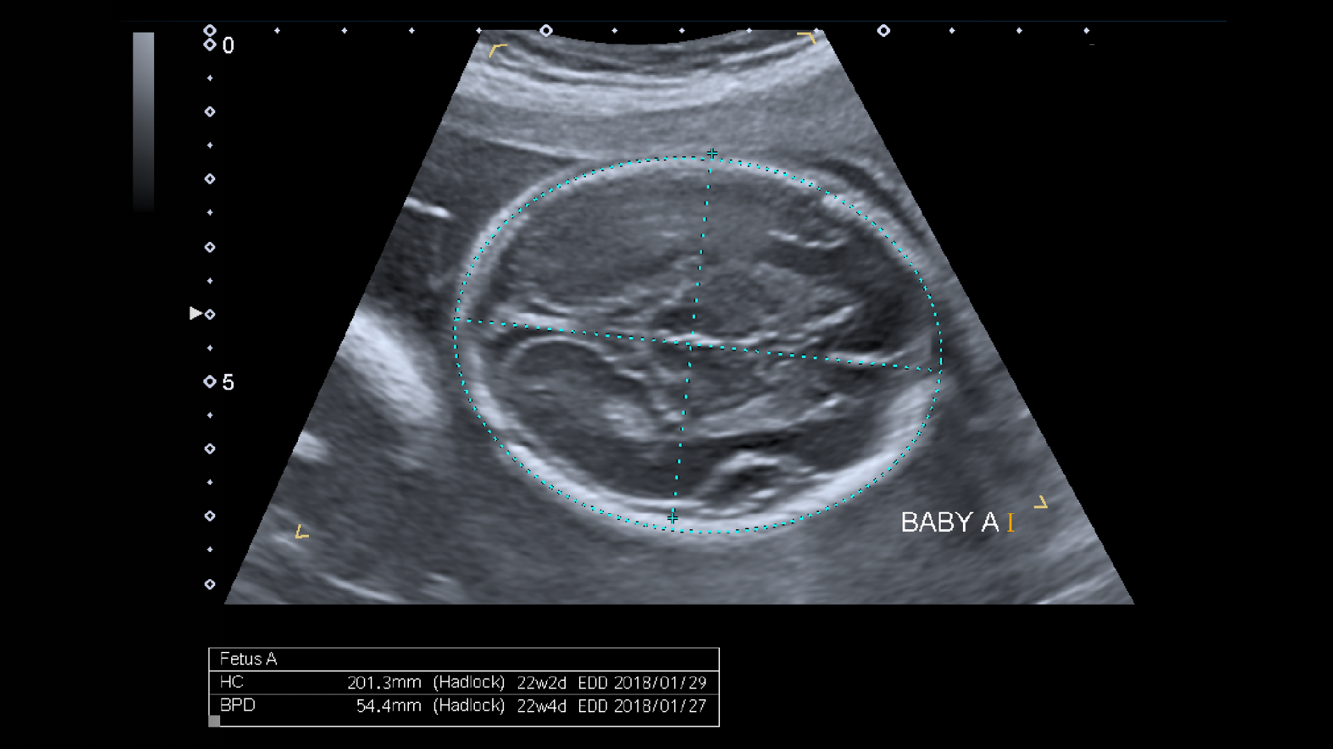 Fetal Biometry: What is BPD on an Ultrasound?