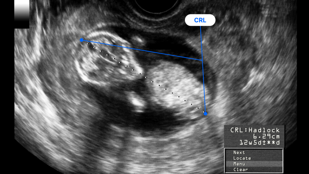 Fetal ultrasound showing the crown rump length (CRL) measurement