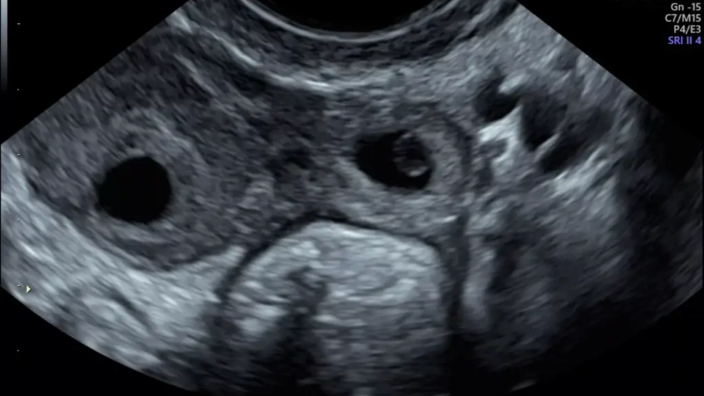 Ectopic Pregnancy in the interstitial portion of the Fallopian tube