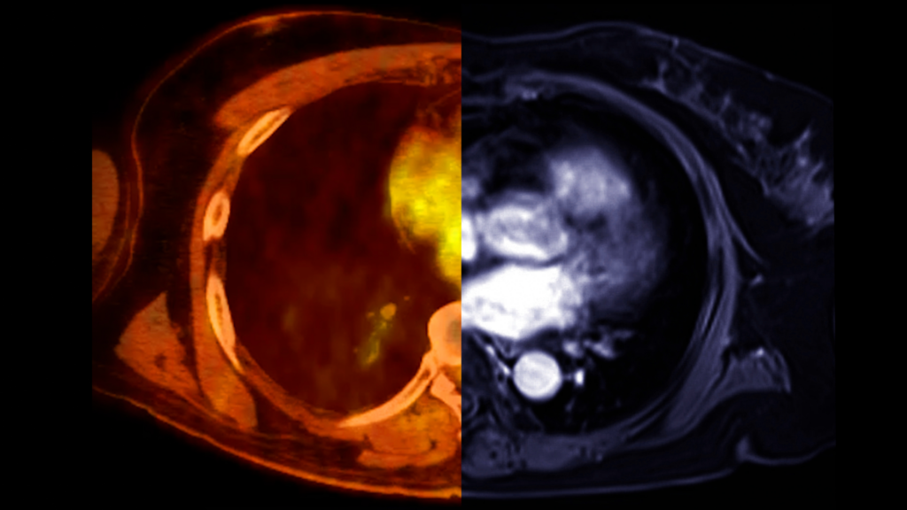 An image showing PET/CT vs MRI scan