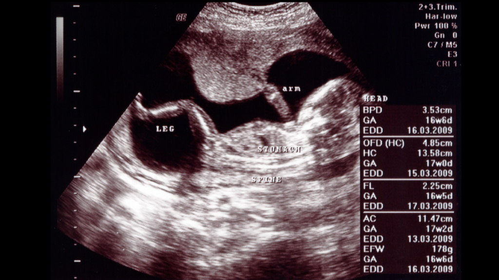Fetal ultrasound showing BPD, FC, HC and other biometric measurements